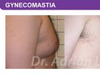 Gynecomastia 9
