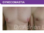 <span>BEFORE:</span> Age: 28 Height: 6’4” Weight: 210lbs<br> <span>AFTER:</span> TISSUE REMOVED: Right: 56gm Left: 21gm LIPO: Right: 150cc Left: 150cc