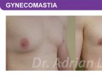 <span>BEFORE:</span> Age: 28 Height: 6’4” Weight: 210lbs<br> <span>AFTER:</span> TISSUE REMOVED: Right: 56gm Left: 21gm LIPO: Right: 150cc Left: 150cc