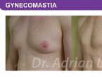 <span>BEFORE:</span> Age: 28 Height: 6’4” Weight: 210lbs<br> <span>AFTER:</span> TISSUE REMOVED: Right: 56gm Left: 21gm LIPO: Right: 150cc Left: 150cc
