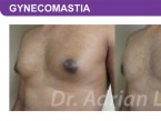 <span>BEFORE:</span> Age: 27 Height: 5’10” Weight: 180lbs<br> <span>AFTER:</span> TISSUE REMOVED: Right: 23gm Left: 26gm LIPO: Right: 200cc Left: 100cc