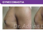 <span>BEFORE:</span> Age: 27 Height: 5’10” Weight: 180lbs<br> <span>AFTER:</span> TISSUE REMOVED: Right: 23gm Left: 26gm LIPO: Right: 200cc Left: 100cc