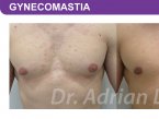 <span>BEFORE:</span> Age: 34 Height: 5’7” Weight: 170lbs<br> <span>AFTER:</span> TISSUE REMOVED: Right: 46gm Left: 37gm LIPO: Right: 100cc Left: 100cc