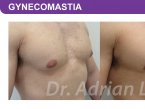 <span>BEFORE:</span> Age: 34 Height: 5’7” Weight: 170lbs<br> <span>AFTER:</span> TISSUE REMOVED: Right: 46gm Left: 37gm LIPO: Right: 100cc Left: 100cc