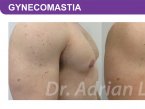 <span>BEFORE:</span> Age: 34 Height: 5’7” Weight: 170lbs<br> <span>AFTER:</span> TISSUE REMOVED: Right: 46gm Left: 37gm LIPO: Right: 100cc Left: 100cc