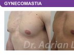 <span>BEFORE:</span> Age: 34 Height: 5’7” Weight: 170lbs<br> <span>AFTER:</span> TISSUE REMOVED: Right: 46gm Left: 37gm LIPO: Right: 100cc Left: 100cc