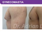 <span>BEFORE:</span> Age: 34 Height: 5’7” Weight: 170lbs<br> <span>AFTER:</span> TISSUE REMOVED: Right: 46gm Left: 37gm LIPO: Right: 100cc Left: 100cc