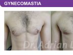 <span>BEFORE:</span> Age: 26 Height: 5’11” Weight: 150lbs<br> <span>AFTER:</span> TISSUE REMOVED: Right: 74gm Left: 43gm LIPO: Right: 100cc Left: 100cc