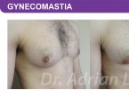 <span>BEFORE:</span> Age: 26 Height: 5’11” Weight: 150lbs<br> <span>AFTER:</span> TISSUE REMOVED: Right: 74gm Left: 43gm LIPO: Right: 100cc Left: 100cc