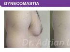 <span>BEFORE:</span> Age: 26 Height: 5’11” Weight: 150lbs<br> <span>AFTER:</span> TISSUE REMOVED: Right: 74gm Left: 43gm LIPO: Right: 100cc Left: 100cc