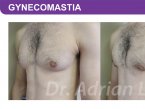 <span>BEFORE:</span> Age: 26 Height: 5’11” Weight: 150lbs<br> <span>AFTER:</span> TISSUE REMOVED: Right: 74gm Left: 43gm LIPO: Right: 100cc Left: 100cc