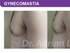 <span>BEFORE:</span> Age: 26 Height: 5’11” Weight: 150lbs<br> <span>AFTER:</span> TISSUE REMOVED: Right: 74gm Left: 43gm LIPO: Right: 100cc Left: 100cc
