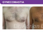 <span>BEFORE:</span> Age: 45 Height: 5’7” Weight: 165lbs<br> <span>AFTER:</span> TISSUE REMOVED: Right: 26gm Left: 34gm