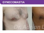 <span>BEFORE:</span> Age: 45 Height: 5’7” Weight: 165lbs<br> <span>AFTER:</span> TISSUE REMOVED: Right: 26gm Left: 34gm