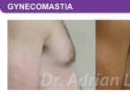 <span>BEFORE:</span> Age: 45 Height: 5’7” Weight: 165lbs<br> <span>AFTER:</span> TISSUE REMOVED: Right: 26gm Left: 34gm