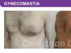 <span>BEFORE:</span> Age: 45 Height: 5’7” Weight: 165lbs<br> <span>AFTER:</span> TISSUE REMOVED: Right: 26gm Left: 34gm