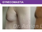<span>BEFORE:</span> Age: 45 Height: 5’7” Weight: 165lbs<br> <span>AFTER:</span> TISSUE REMOVED: Right: 26gm Left: 34gm