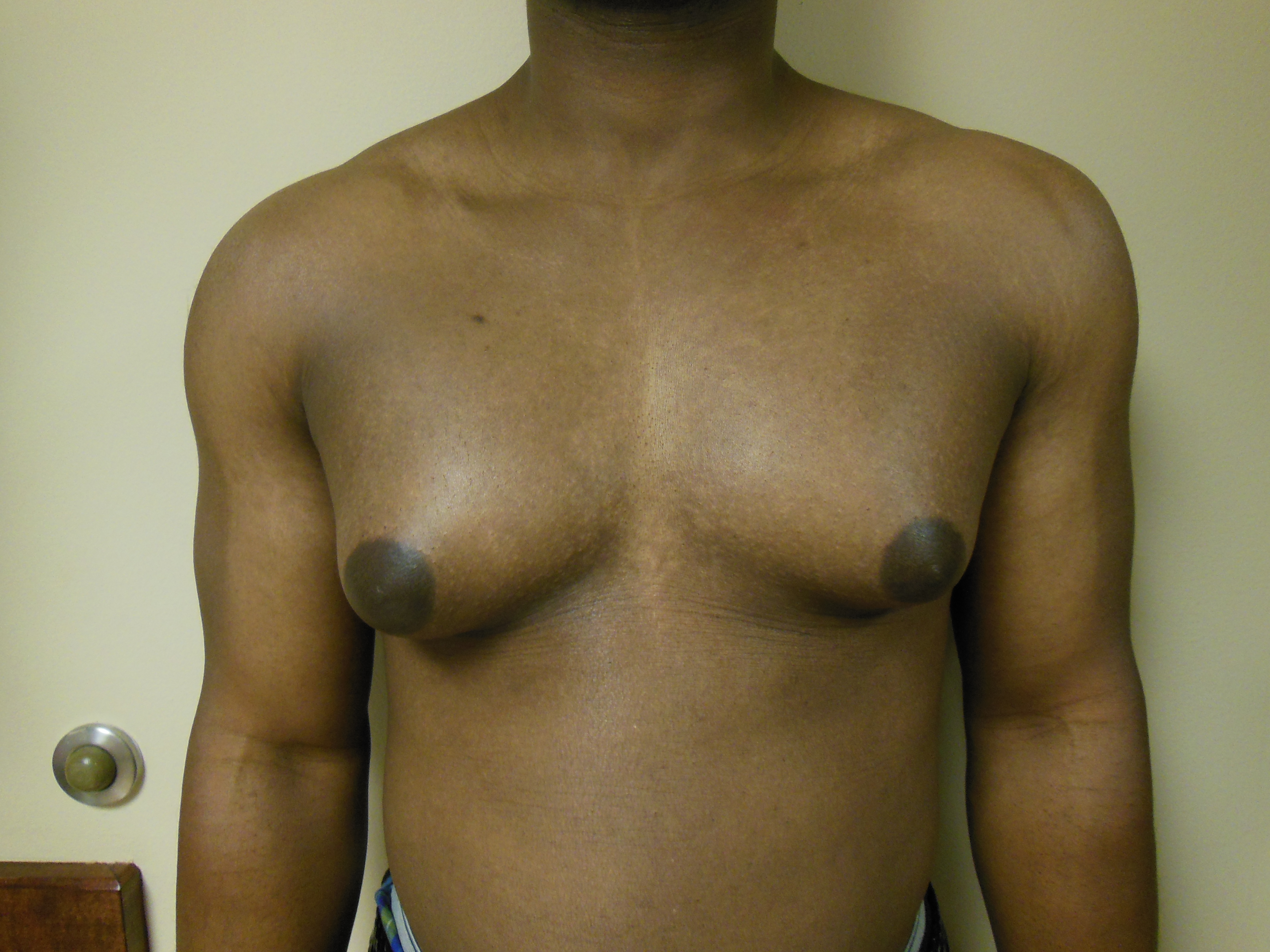 Droopy Nipple Steroid 💉💪Induced Gynecomastia Gland Removal By Dr