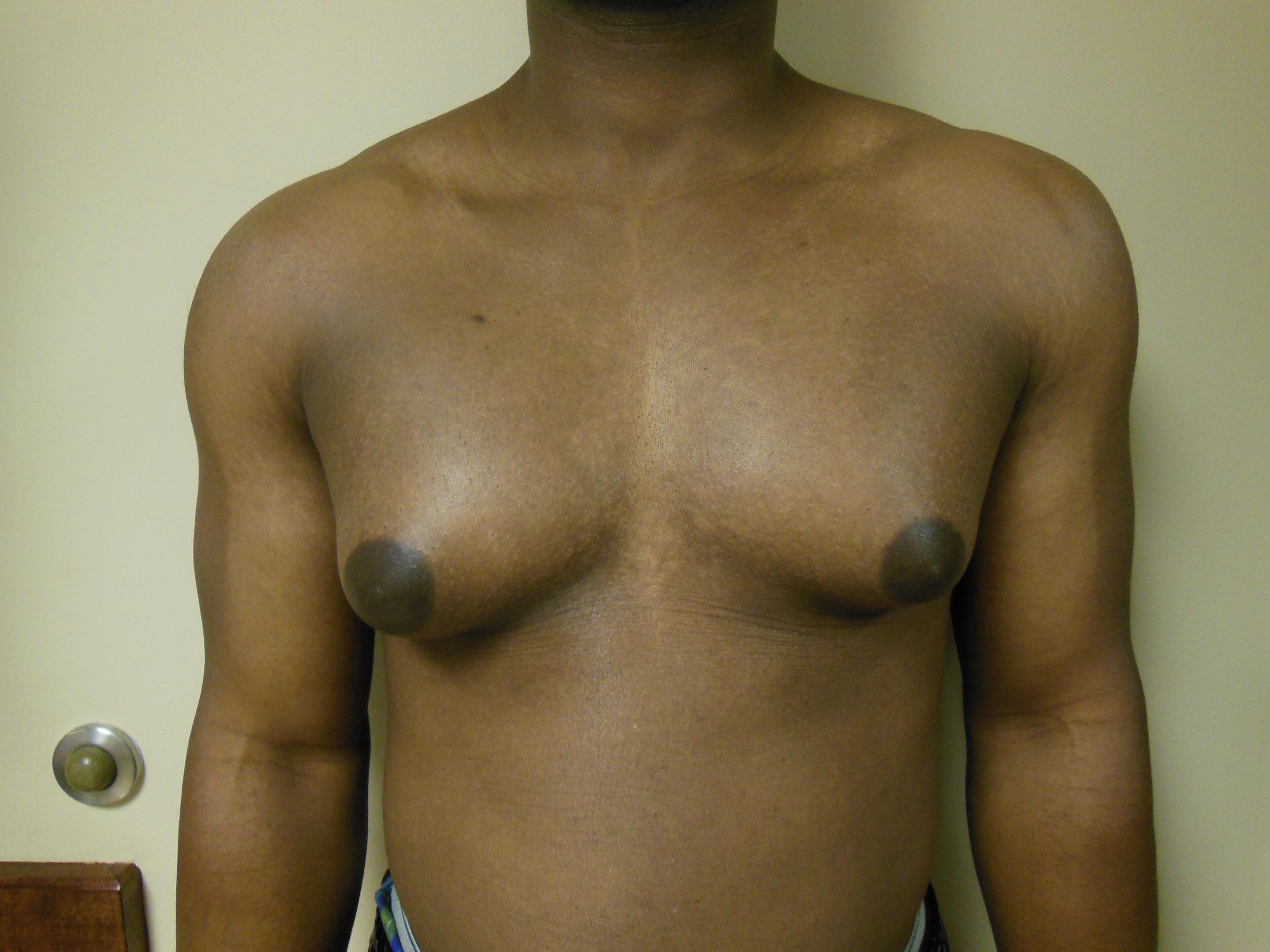 Body Builder Surgery | Philadelphia & South Jersey | Dr. Adrian Lo