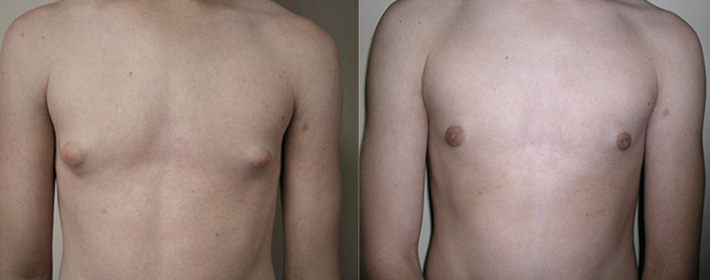 Gynecomastia FAQs, Philadelphia & South Jersey