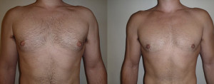 gynecomastia-03