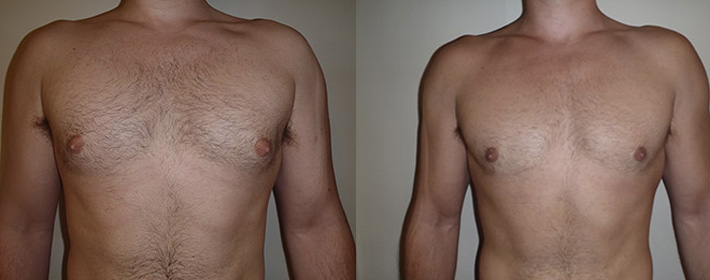 Gynecomastia FAQs, Philadelphia & South Jersey