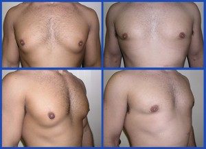 Body Builders’ Gynecomastia