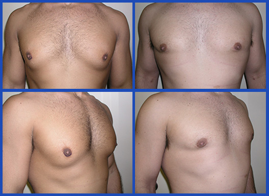 Body Builders' Gynecomastia