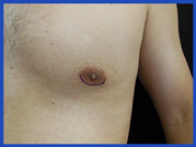 incision-pic