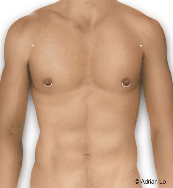 Above image shows armpit incision used for liposuction and nipple/areolar incision used for gland removal.