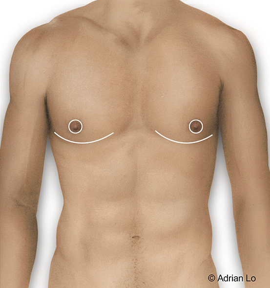 Above image shows incisions used for the male breast reduction procedure.
