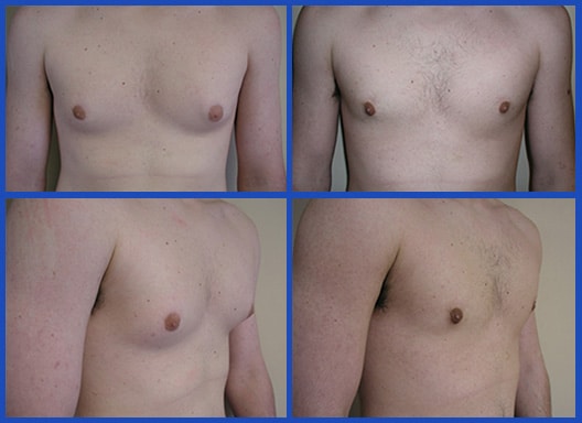 Teen Gynecomastia