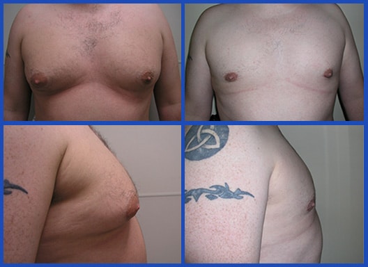 Adult Gynecomastia