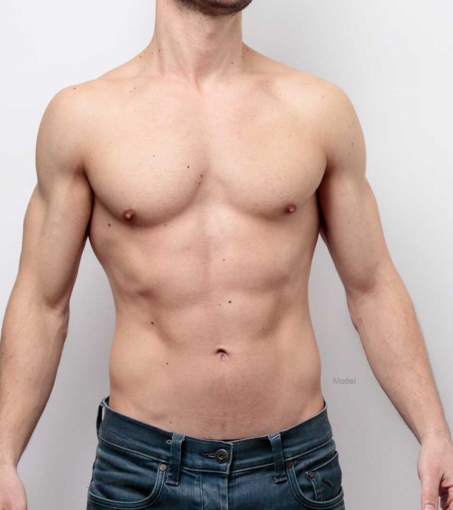 Gynecomastia Model